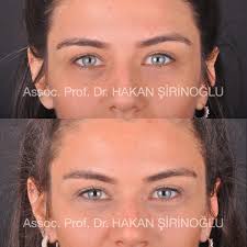 Browpexy is a brow lift surgery which is performed to correct the sagging brows over the eyelids. Temporal Lifting Is A Procedure Doc Dr Hakan Sirinoglu Facebook