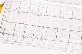 Image result for Hyperkalemia