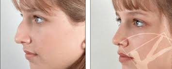Faire dégonfler son nez après. La Rhinoplastie De A A Z Tout Sur La Chirurgie Esthetique Du Nez