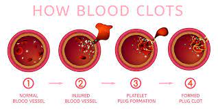 What Does It Mean When Your Child Has Immune Thrombocytopenia Purpura  (Itp)? - Children's Hospital & Medical Center