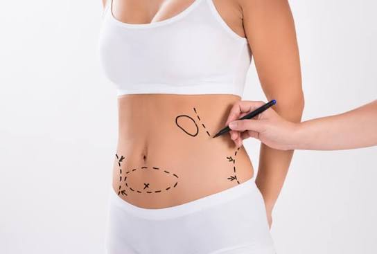 Maintaining Long-Term Results After Liposuction in Dubai | FYI