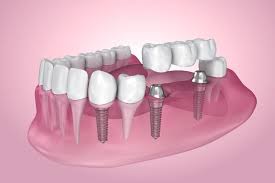 How much does it cost to have a molar tooth removed where you live? Dental Implant Tooth Replacement Atlas Dental Toronto