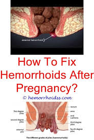 Pin On Hemorrhoid Surgery