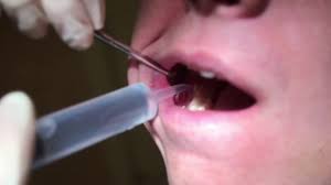 Jun 14, 2020 · how to clean out wisdom teeth holes. 3rd Molar Irrigation Video Youtube