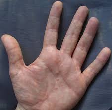 Dyshidrose Ist Ein Ekzem Dermatitis Charakterisiert Durch Hautausschlag Mit Juckenden Blaschen An Handen Und Fussen Di Ekzem Hautausschlag Ekzeme Hausmittel