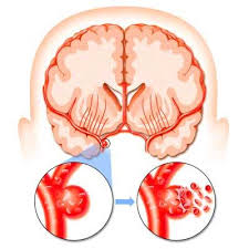 Accidentul vascular cerebral (avc) are loc atunci cand fluxul sanguin este brusc intrerupt catre o parte a creierului. Ce TulburÄri Pot ApÄrea DupÄ Un Accident Vascular Cerebral