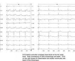 Image result for Atrioventricular Block
