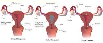 Vaginal bleeding in early pregnancy. Bleeding During Pregnancy Mama Net