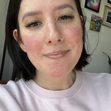 BEST of Admiral, Seattle, WA Acne Treatment