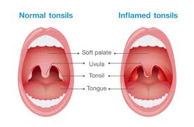 Chronic Sore Throat Integrated Ear Nose And Throat Of Lone Tree Colorado