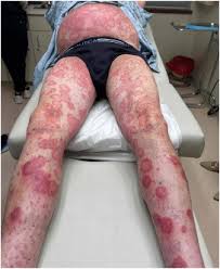 Image result for Generalized Rash