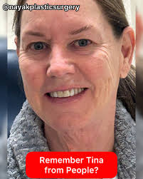 Bethany, 52, is 7 days after her Omakase Facelift®️She has a disarming,  gentle sweetness about her. Her surgery included:✓ Deep plane extended  facelift✓ Deep necklift (#neckbynayak)✓ Minimal incision browlift ✓ Upper  blepharoplasty