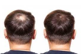 Alopecia is the general medical term for hair loss. Finasteride For Hair Loss Should You Try It Longevity Live