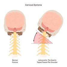 Image result for Lower Cervical Intramuscular Injection