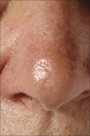 cancer elsewhere, e.g., from a lung, kidney, breast, or skin cancer. Basal Cell Carcinoma Pathophysiology Wikidoc