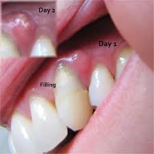 Treatments for gum boils not only will the abscess need to be drained, but you will likely need antibiotics to fight the remaining infection. How Do I Treat A Gum Boil