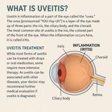 Image result for Uveitis