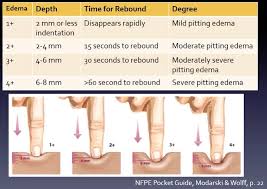 Image result for Edema Exam