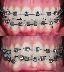 You will have tender teeth and gums when you reach home after your removal appointment. Stages Of Change In Braces Orthodontic Associates