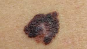 Muttermale die schwarz werden, gelten als verdächtig. Muttermale Keinesfalls Mit Laser Oder Ipl Entfernen Hautarztpraxis Dr Kirschner