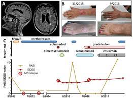 Multiple sclerosis (ms) is an unpredictable disease of the central nervous system that disrupts the flow of information within the brain, and between the brain and body. A Case Of Concomitant Psoriasis And Multiple Sclerosis Secukinumab And Rituximab Exert Dichotomous Effects In Two Autoimmune Conditions Multiple Sclerosis And Related Disorders