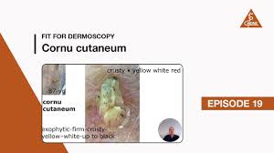 Image result for cornu cutaneum)
