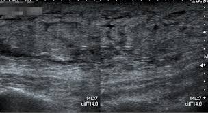 Ultrasound follow up breast ultrasound is a rash isn't the only visual symptom of inflammatory breast cancer. Inflammatory Carcinoma Left Breast Radiology Case Radiopaedia Org