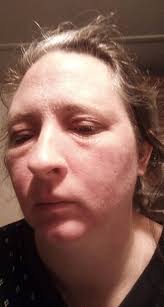 What is it with the burning skin? I feel like I have a horrible sunburn