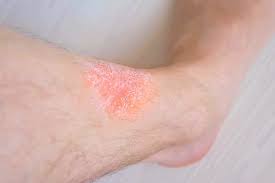 Image result for Stasis Dermatitis