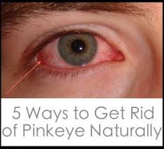 5 Ways To Get Rid Of Pinkeye Naturally With Images Pink Eye Treatment Pink Eyes Red Eyes Remedy