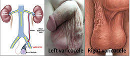 Image result for Varicocele