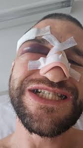 Other than ending the year w broken face, jaw wired shut, n broke af.. 24'  was dope!! 😂, 25' bouncin back asap, Happy Fuckin New Year!! , @memeseem  appreciate the edit brotha 🙏