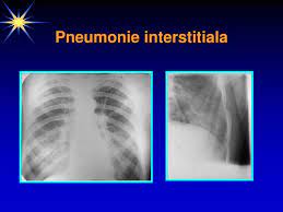 Investim constant în cei mai buni specialiști și. Pneumonia Stafilococica Ppt Katebasma