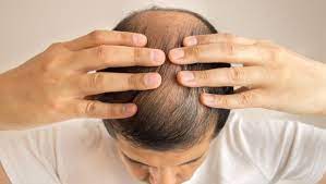 Some conditions and medical treatments, such as chemotherapy for cancer, can result in the loss of hair all over your body. Balding Issues In Short Men Could Also Indicate Cancer Risk Ndtv Food