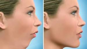 What is Genioplasty for Men Jaw