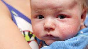 Jun 09, 2020 · these tips are useful for caring for your baby's skin while he or she has acne: Baby Acne Causes Symptoms And Treatment