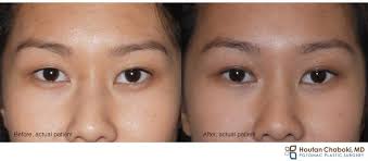 Brow lift surgery in iran with experienced plastic surgeons. Asian Blepharoplasty Creating A Double Fold With Upper Eyelid Surgery