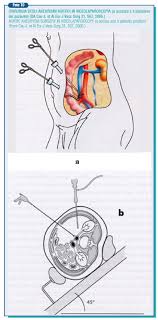 Informazioni a cura della dott.ssa brioschi, chirurgo vascolare del centro medico santagostino. Leadership Medica La Chirurgia Degli Aneurismi Dell Aorta Addominale Tradizione Ed Innovazione