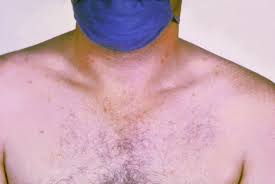 The condition is characterized by severe fever, acute systemic symptoms, with occasionally ser. Typhoid Fever Wikipedia
