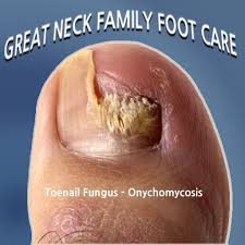 On the other hand, fungal infections are caused by fungi. What Causes Toenail Fungus Keep Your Feet In The Sand