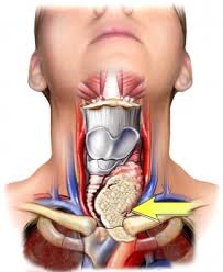 Here are some signs to look out for. Thyroid Cancer India Pdf Ppt Case Reports Symptoms Treatment