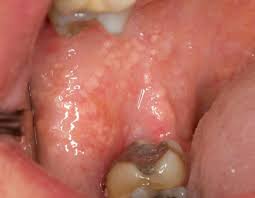 Wund Im Mund Es Ist Zum Gluck Nicht Immer Krebs Zwp Online Das Nachrichtenportal Fur Die Dentalbranche