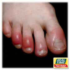 Image result for Chilblains
