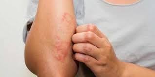 Alkohol mengandung desinfektan dan anti mikroba. Cara Mengatasi Gatal Membandel Pada Kulit Secara Cepat Dan Sembuh Total