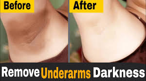 Dark underarms may be caused by dead skin cells that have accumulated there, so exfoliating can reduce the dark. How To Lighten Dark Underarms At Home Get Rid Of Dark Armpits Naturally Youtube