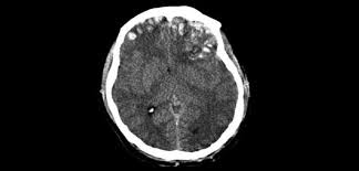 That disruption may be related to depression, memory problems and suicidal behavior common in cases of cte. Nfl Brains Show Signs Of Cte Orthopedics This Week