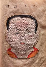 Image result for Smallpox