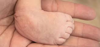 Image result for Clubfoot