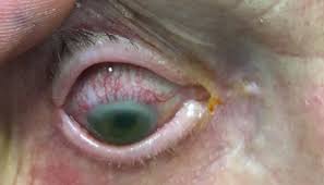 Image result for Eye Pain without Redness