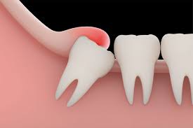 Early stage wisdom teeth real pictures. Signs That You Should Get Your Wisdom Tooth Extracted